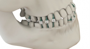 Summit Medical Launches Non-Invasive Jaw Fixation Device