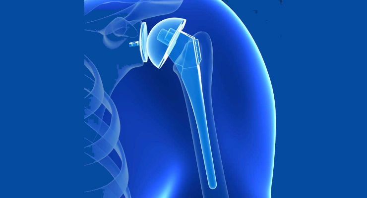 Asia-Pacific Shoulder Replacement Market to Hit $95.8 Million by 2023