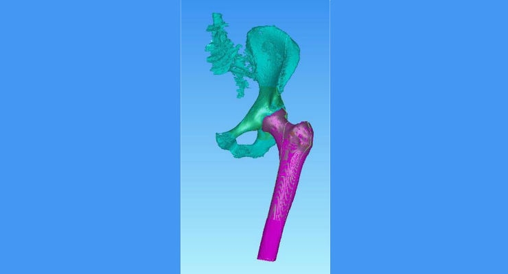 ConforMIS Announces FDA 510(k) Clearance for iTotal Hip System