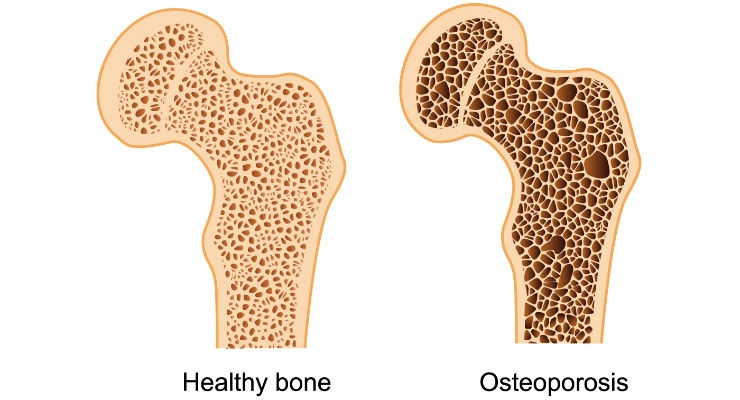 Awareness, Adherence Key to Improved Osteoporosis Care