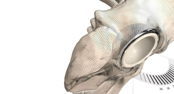 Patient-Specific Simulation Breakthroughs for Total Hip Replacements