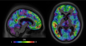 AI Predicts Dementia Before Onset of Symptoms
