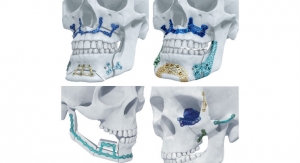 DePuy Synthes Launches 3D-Printed Titanium Facial Reconstruction Implants in U.S.