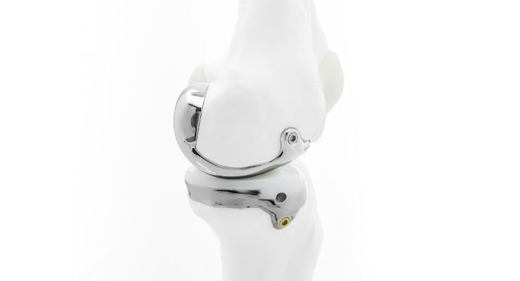 Bodycad Reports First Use of Its Unicompartmental Knee System in Patients
