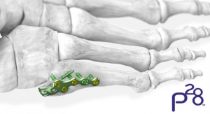 Paragon 28 Launches 5th Metatarsal Fracture Specific Plating System