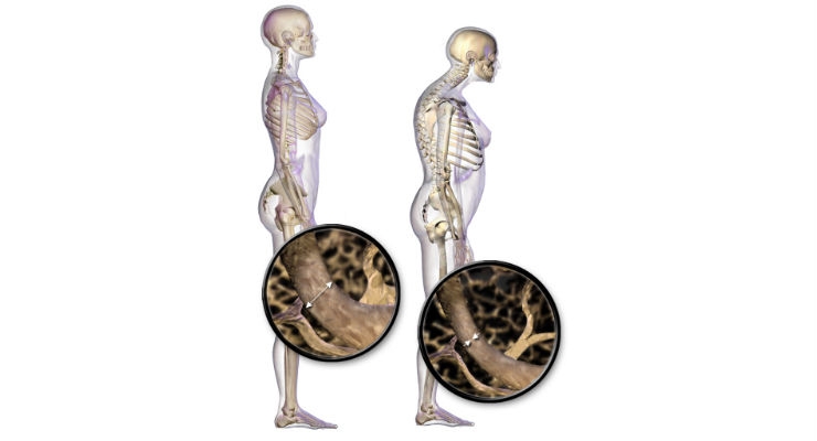 New European Effort Targets Early-Stage Osteoporosis Detection