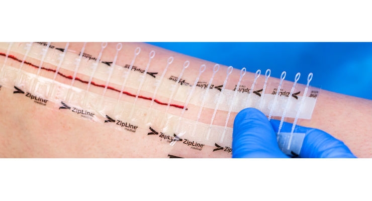 Zip Surgical Skin Closure Reduces Post-Discharge Costs, Clinic Calls for TKA