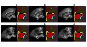 Augmented Tongue Ultrasound for Speech Therapy
