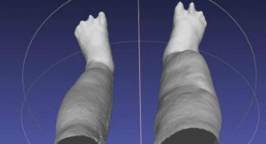 Portable 3D Scanner Assesses Patients with Elephantiasis