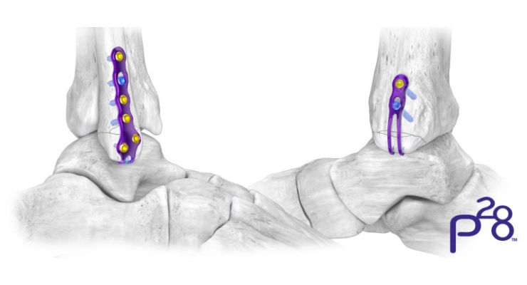 Paragon 28 Adds Hook Plates to Gorilla Ankle Fracture Plating System