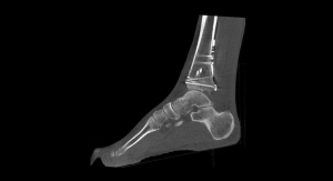 Advanced Software Offers Metal Artifact Reduction for Extremities