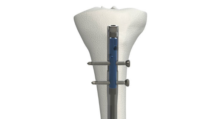 510k, CE Mark for OrthoXel’s Tibial Nail System