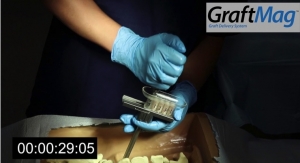 Spine Wave Announces the Commercial Launch of the GraftMag Graft Delivery System