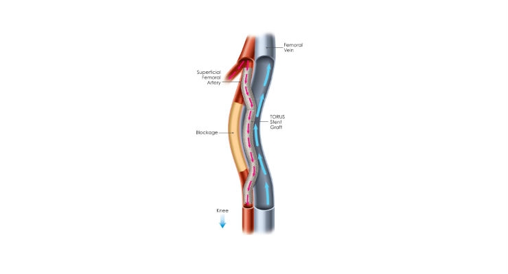 First Patient Treated in PQ Bypass DETOUR II Trial Evaluating New Treatment for Clogged Leg Arteries