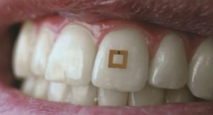 Tiny Tooth-Mounted Sensors Can Track What You Eat
