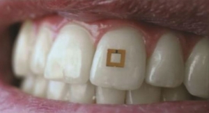 Tiny Tooth-Mounted Sensors Can Track What You Eat