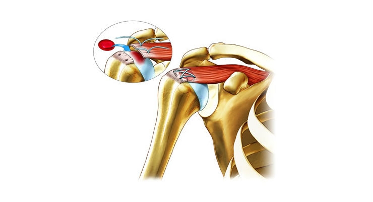 Ortho RTi Reveals Compelling Data from Ortho-R Pilot Rotator Cuff Repair Study