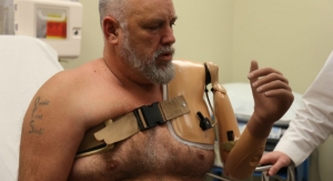 Arkansas Man Fitted for Robotic Arm Controlled by Thought
