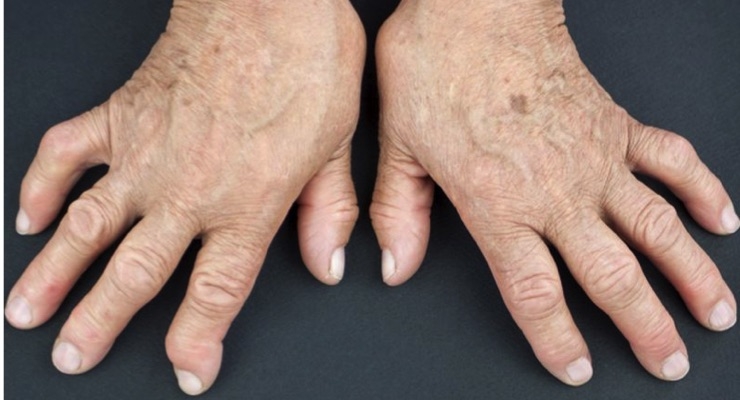 U.S. Pilot Trial to Evaluate First Bioelectronic Device to Treat Rheumatoid Arthritis