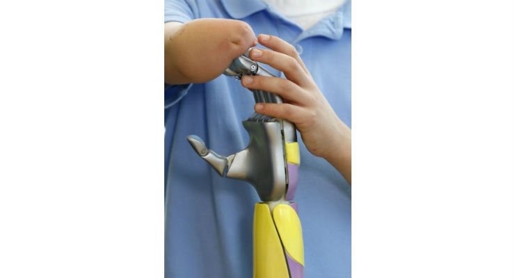First U.S. Clinical Trial of 3D Printed Bionic Arms for Children Begins