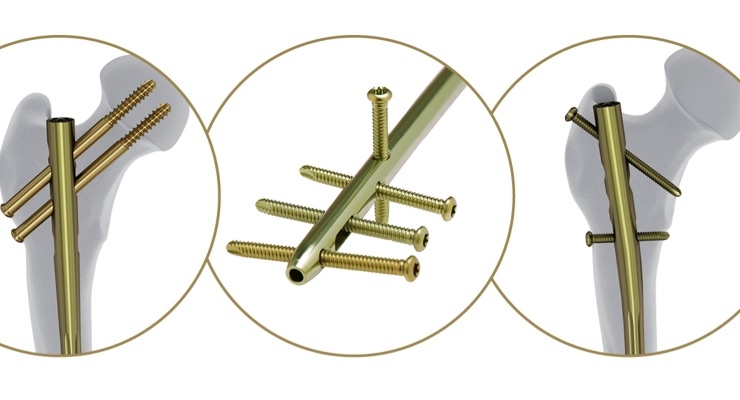 Advanced Nailing System | DePuy Synthes