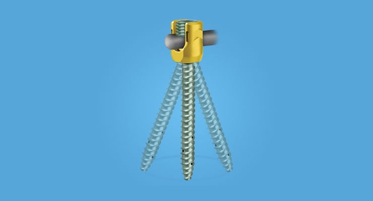 Globus Medical Launches Cement Augmented Pedicle Screw System