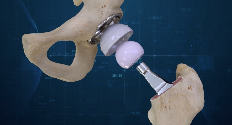 First Conformis 3D Total Hip Replacement Surgeries Completed