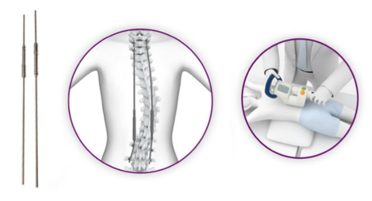 NuVasive Launches MAGEC X for Early Onset Scoliosis Treatment in the UK