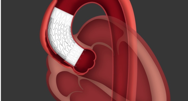 Gore Announces Successful Patient Implant of Endovascular Stent Graft for the Ascending Aorta