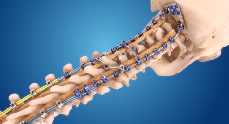  Medtronic Launches the Infinity OCT Spinal System at NASS