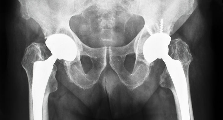 What Are the Cost-Effective Implants in Hip Replacement Surgery?