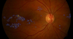 Saving Sight: Using AI to Diagnose Diabetic Eye Disease