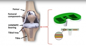 Smart, Self-Powered Knee Implants Could Reduce Number of Replacement Surgeries