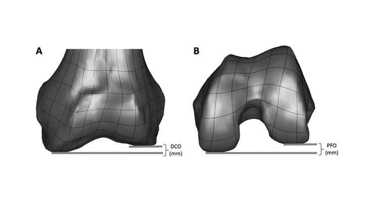 New Data Supports Use of Conformis Customized Knee Implants to Match Anatomic Variability