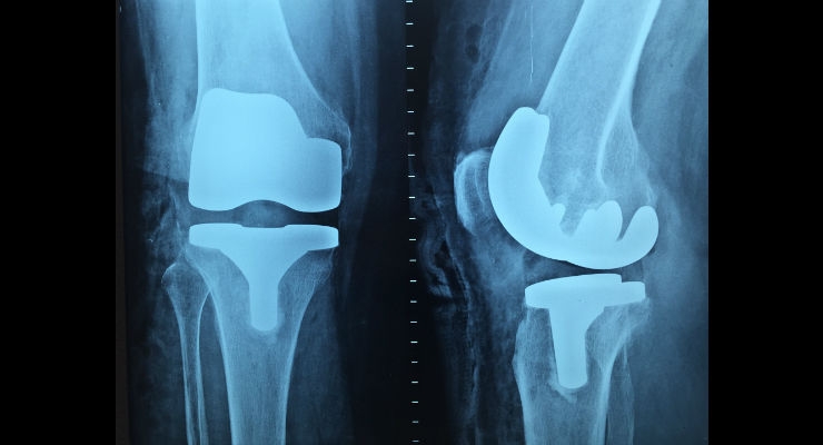 The Changing World Around Orthopedic Implants