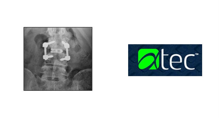 Alphatec Launches TLIF IdentiTi Posterior Curved Porous Titanium Interbody Implant System