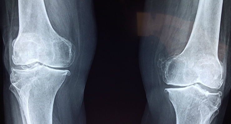 AOSSM News: Study Suggests Surgery a Better Option for Older Patients with Meniscus Tears