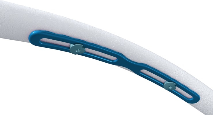 Zimmer Biomet Launches Intrathoracic Fixation System