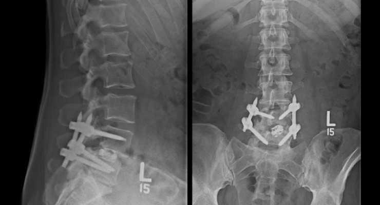 Electrical Stimulation Aids in Spinal Fusion