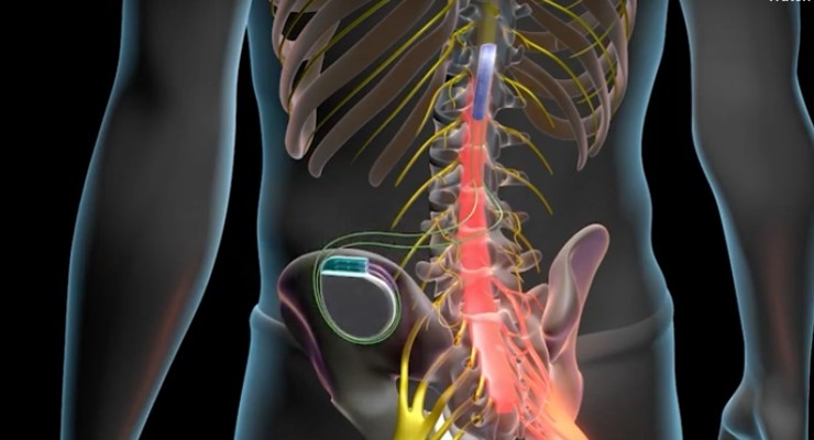 Closed-Loop Technology Significantly Helps Some Back Pain Sufferers –  Consult QD