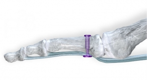 Paragon 28 Launches Sterile Kit Configuration to Streamline Delivery of Hammertoe, Plantar Plate Fix