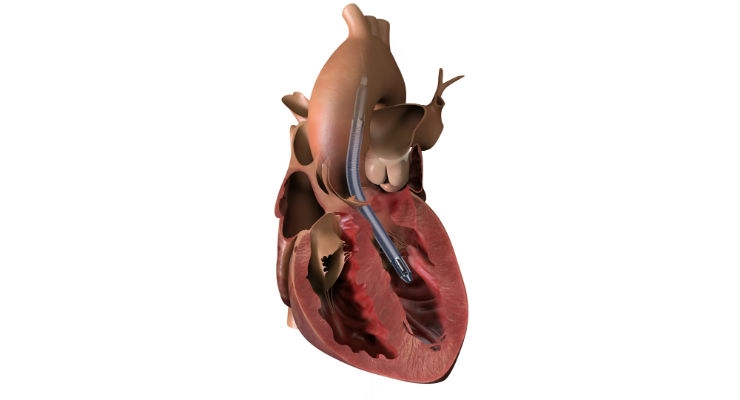 First U.S. Patients Treated With a Minimally Invasive, Forward Flow Heart Pump