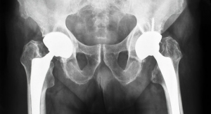 RSIP Vision Launches AI-Based Total Hip Replacement Solution