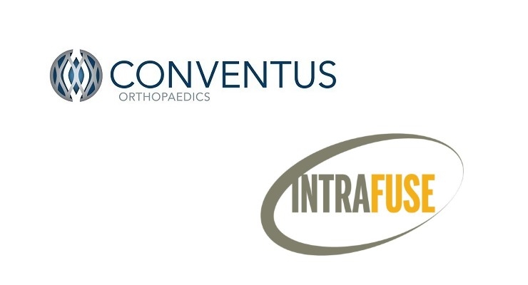 Conventus Acquires Intramedullary Tech from IntraFuse