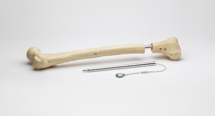 Orthofix Completes Acquisition of FITBONE Limb Lengthening System 