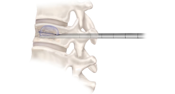 Medtronic Launches New Directional Cannula for Balloon Kyphoplasty