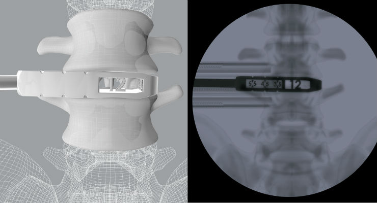 CoreLink Releases Oblique Lumbar Interbody Fusion Instrument Set