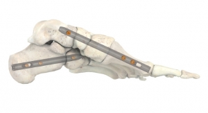 Stryker’s T2 ICF Nail System Offers Foot Surgeons New Option