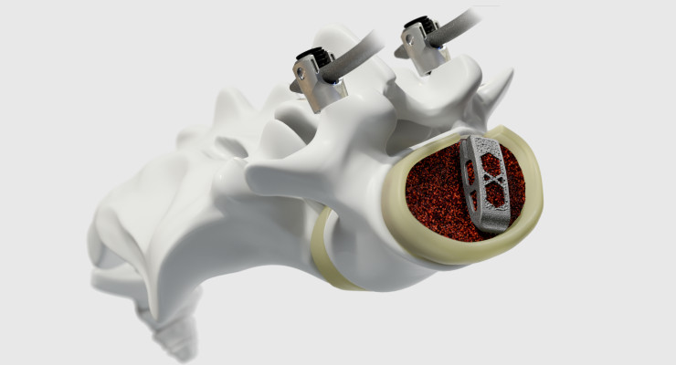 NASS News: Medtronic Launches Adaptix Interbody System