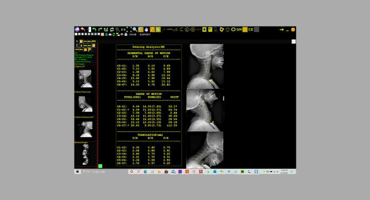 20/20 Imaging Unveils Digital Penning Analysis Tool for Cervical Spine Evaluation 